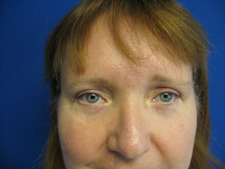 Blepharoplasty Before & After Image
