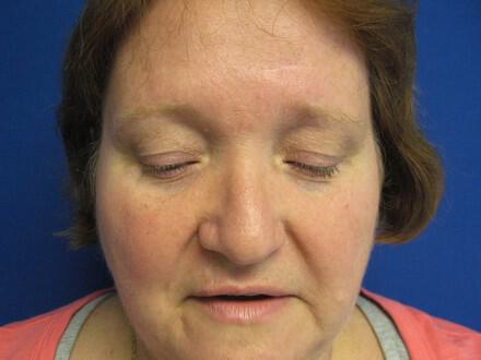 Blepharoplasty Before & After Image