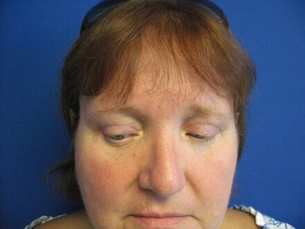 Blepharoplasty Before & After Image