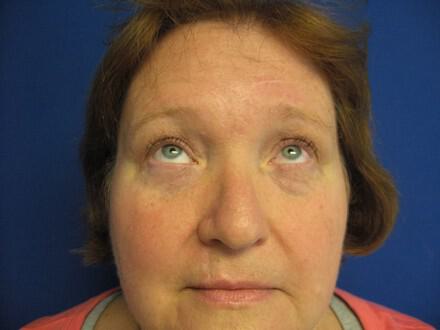 Blepharoplasty Before & After Image