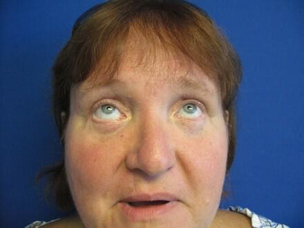 Blepharoplasty Before & After Image