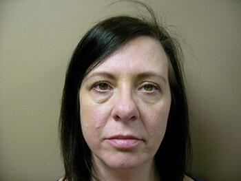 Blepharoplasty Before & After Image