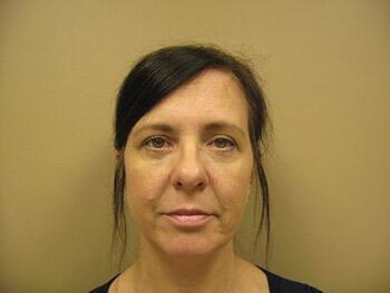 Blepharoplasty Before & After Image