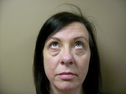 Blepharoplasty Before & After Image