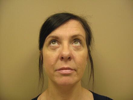 Blepharoplasty Before & After Image