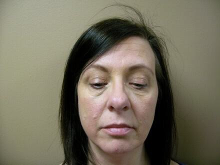 Blepharoplasty Before & After Image