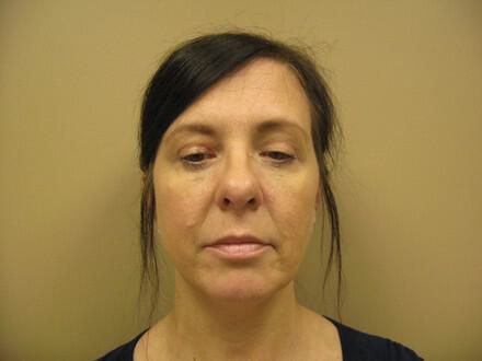 Blepharoplasty Before & After Image