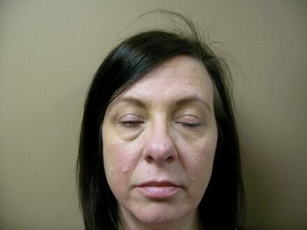 Blepharoplasty Before & After Image