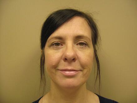 Blepharoplasty Before & After Image