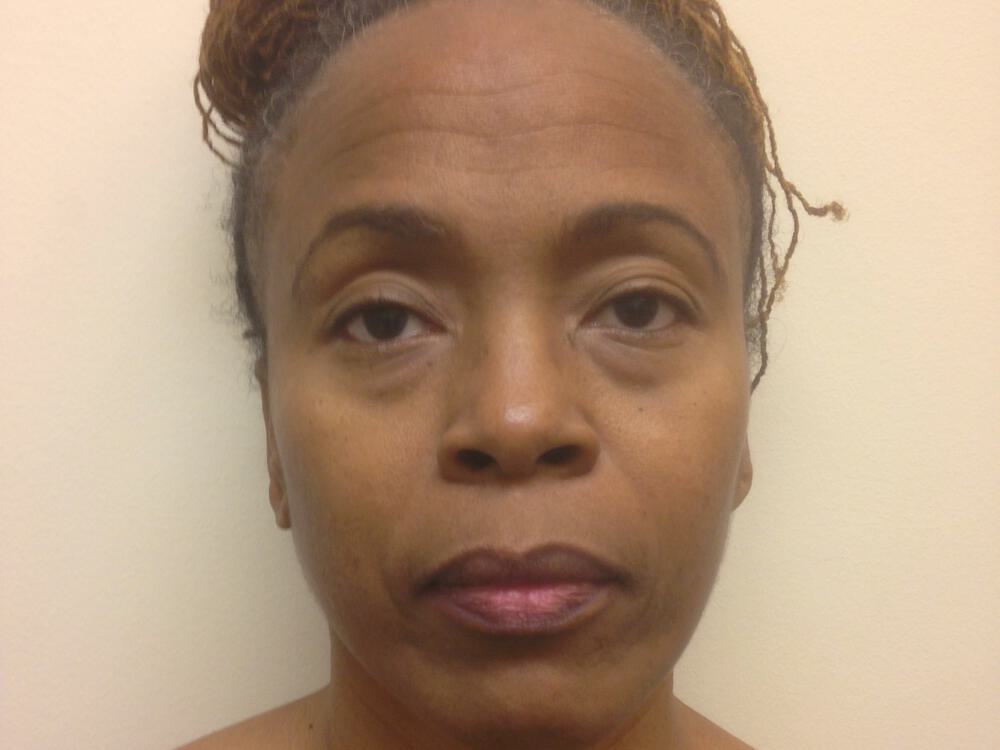 Blepharoplasty Before & After Image