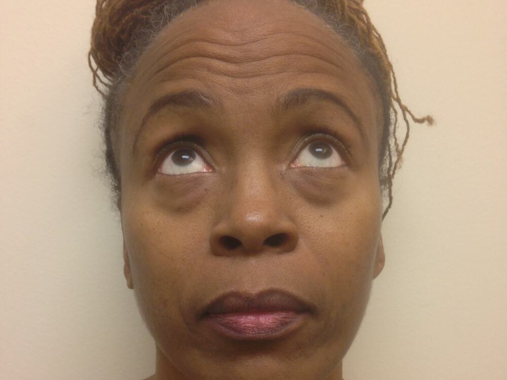 Blepharoplasty Before & After Image