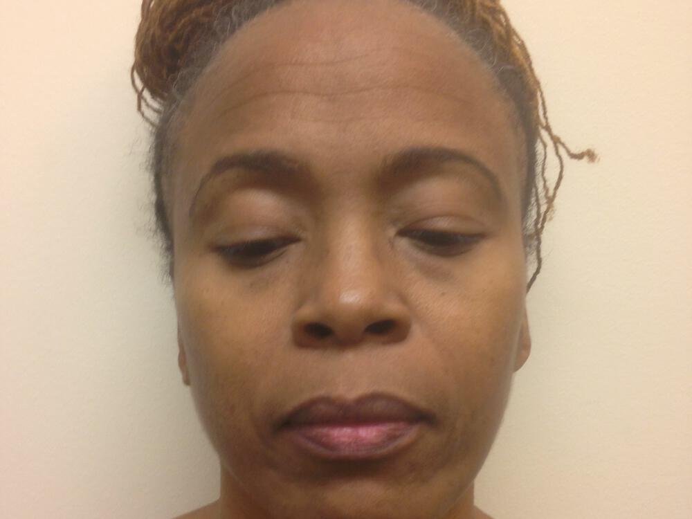 Blepharoplasty Before & After Image