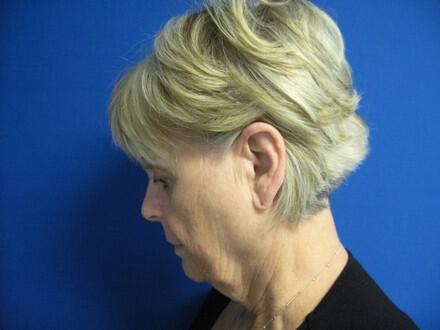 Facelift Before & After Image