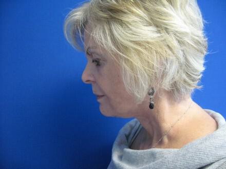 Facelift Before & After Image