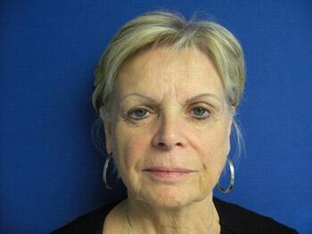 Facelift Before & After Image