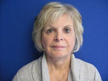 Facelift Before & After Image