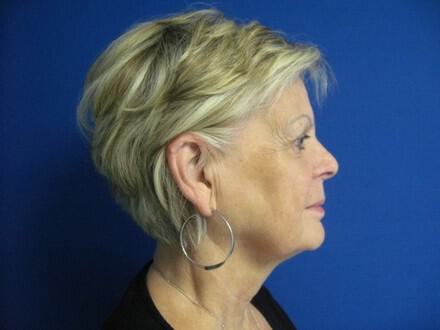 Facelift Before & After Image