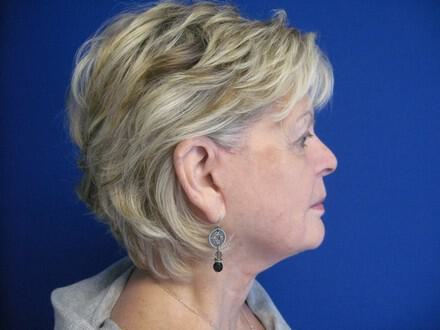 Facelift Before & After Image