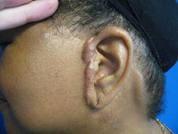 Facelift Before & After Image