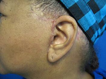 Facelift Before & After Image