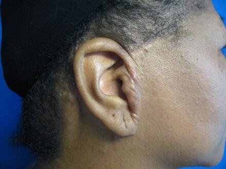 Facelift Before & After Image