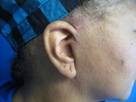 Facelift Before & After Image