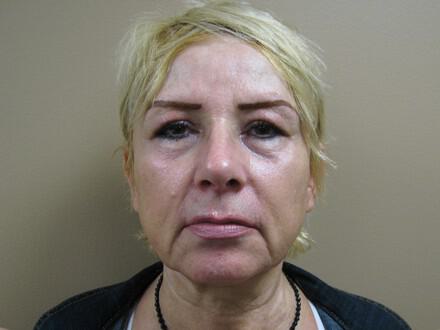 Facelift Before & After Image