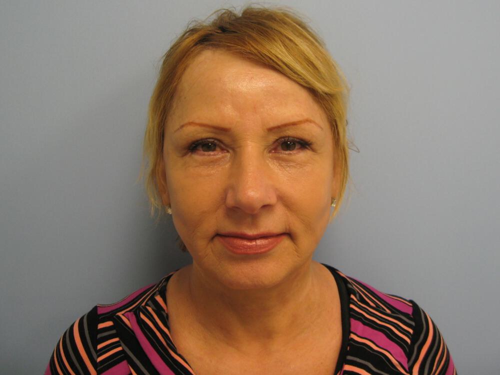 Facelift Before & After Image