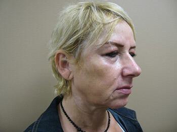 Facelift Before & After Image
