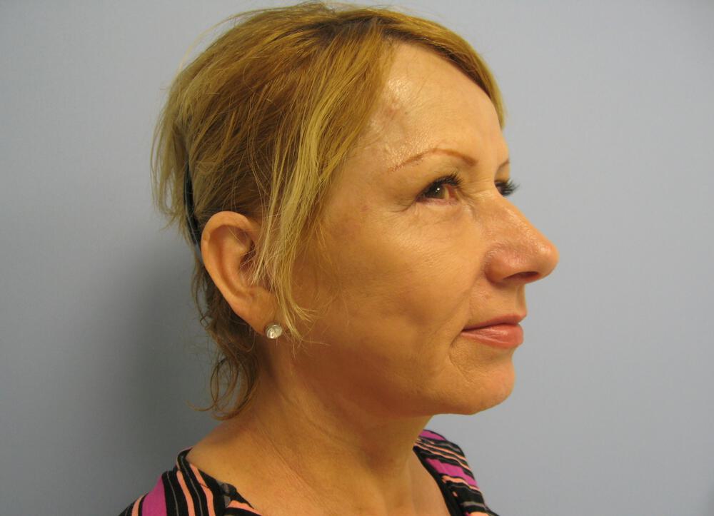 Facelift Before & After Image