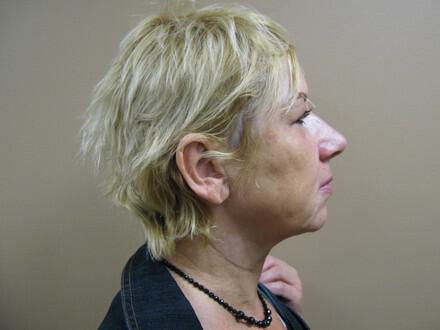 Facelift Before & After Image