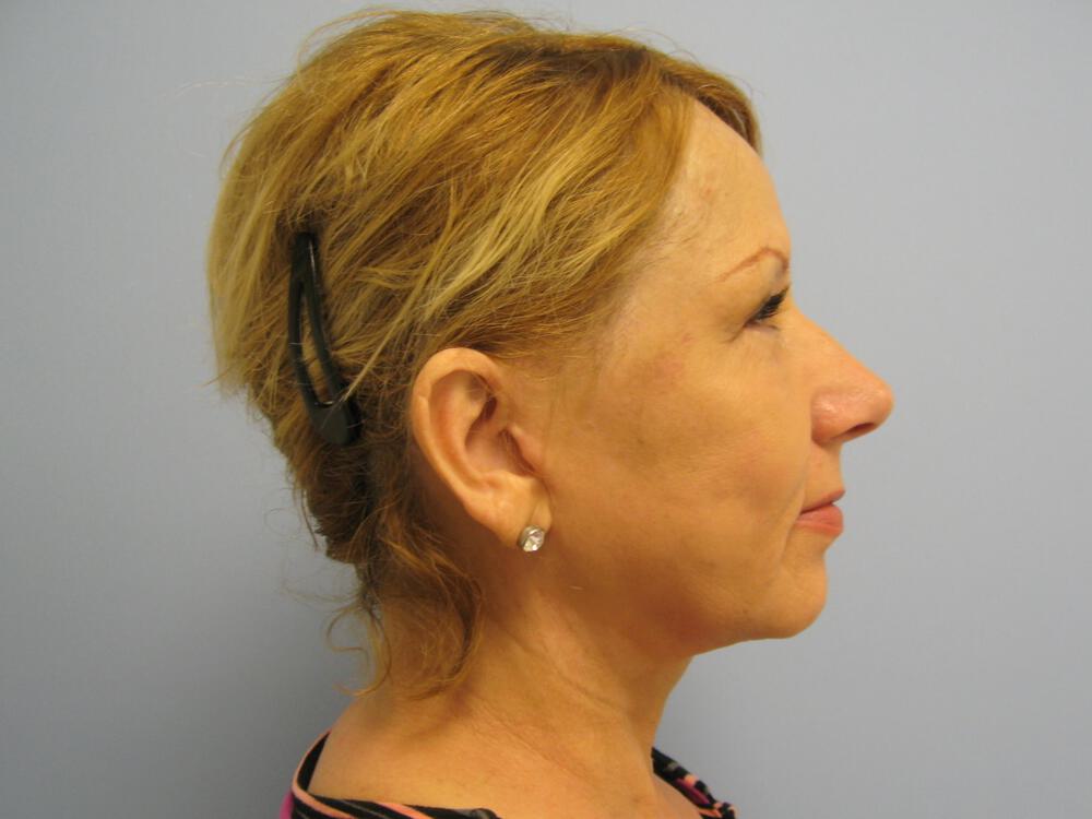 Facelift Before & After Image