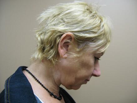 Facelift Before & After Image