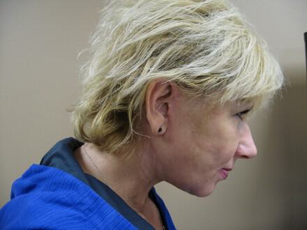 Facelift Before & After Image