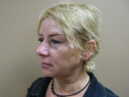 Facelift Before & After Image