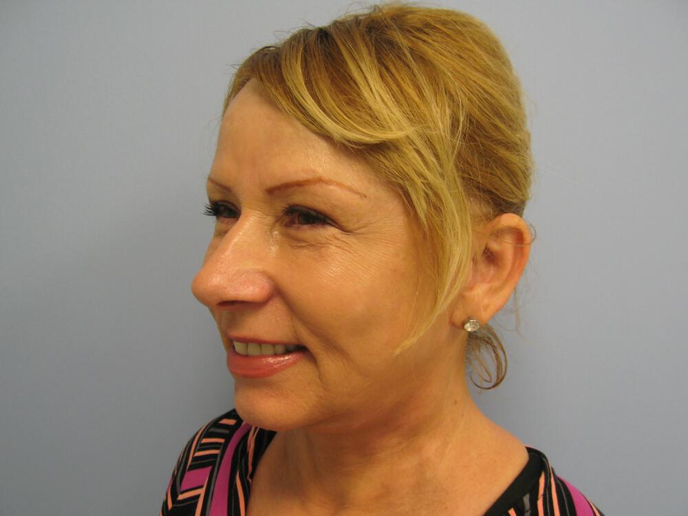 Facelift Before & After Image