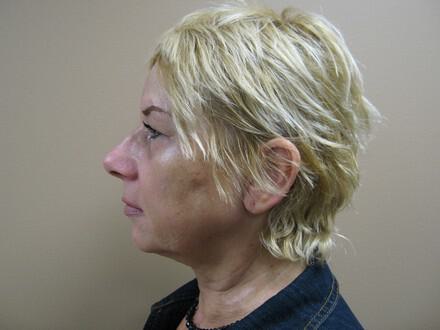 Facelift Before & After Image