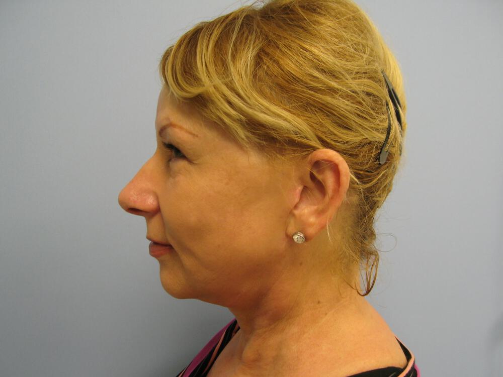 Facelift Before & After Image
