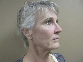 Facelift Before & After Image