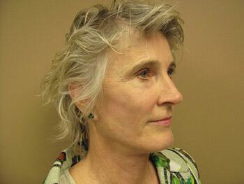 Facelift Before & After Image