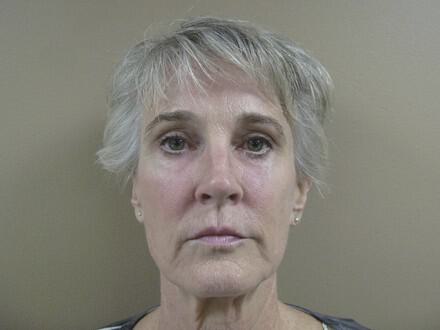 Facelift Before & After Image