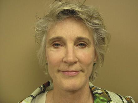 Facelift Before & After Image