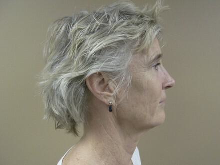 Facelift Before & After Image