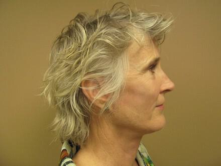 Facelift Before & After Image
