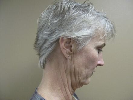 Facelift Before & After Image