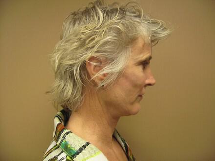 Facelift Before & After Image