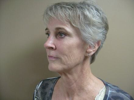 Facelift Before & After Image