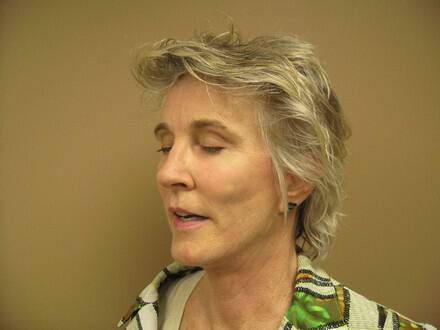 Facelift Before & After Image