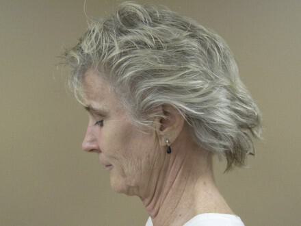 Facelift Before & After Image