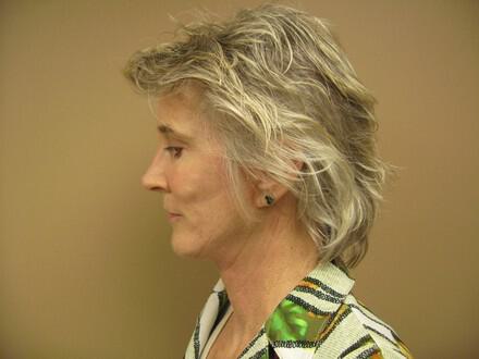 Facelift Before & After Image